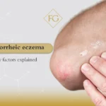 Seborrheic eczema