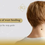 Stages of wart healing