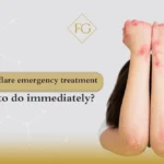 Psoriasis flare emergency treatment