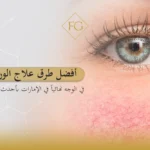 علاج الوردية في الوجه نهائياً