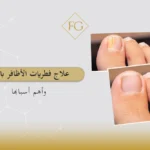 علاج فطريات الأظافر بالليزر