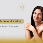 early signs of vitiligo