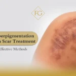 Hyperpigmentation burn scar treatment