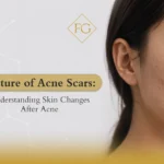 texture of acne scars