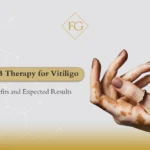 uvb therapy for vitiligo