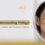 vitiligo skin condition