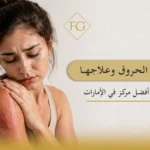 آثار الحروق وعلاجها