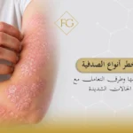أخطر أنواع الصدفية