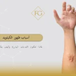 أسباب ظهور الكيلويد