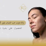 إزالة ندوب حب الشباب بليزر CO2