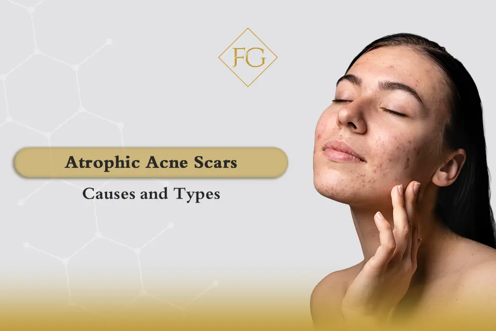 Atrophic acne scars