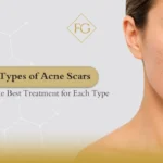 Types of Acne Scars and Treatment