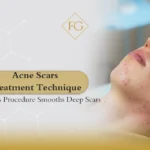 Acne Scars Treatment Technique