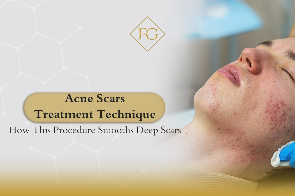 Acne Scars Treatment Technique