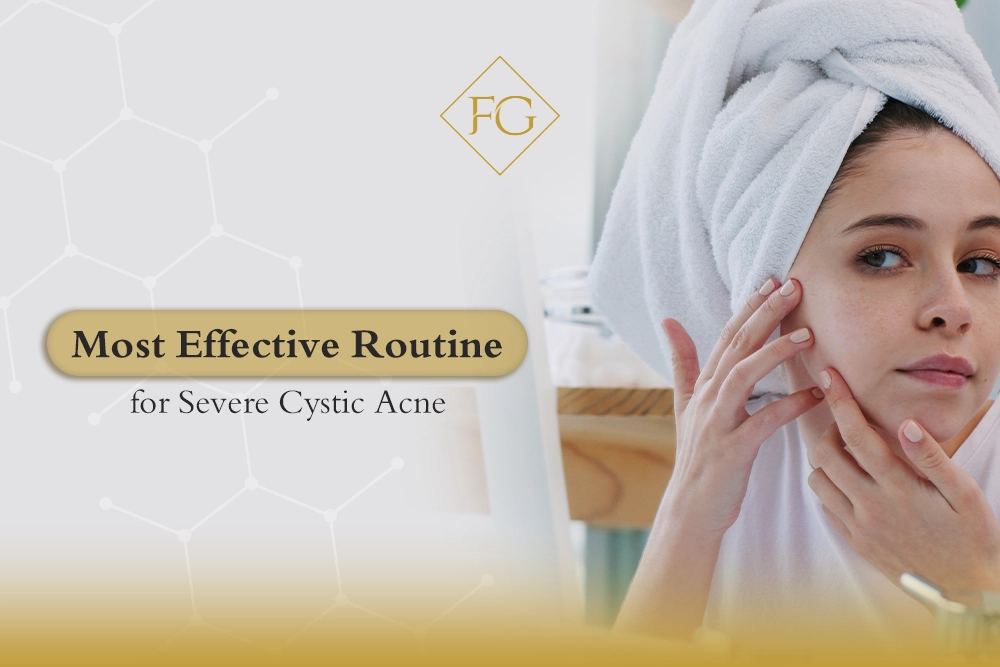 Severe Cystic Acne