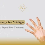 Therapy for Vitiligo