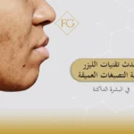 تقنيات الليزر لإزالة التصبغات العميقة