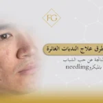 طرق علاج الندبات الغائرة