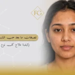 تصبغات ما بعد حب الشباب