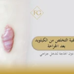 الكيلويد بعد الجراحة