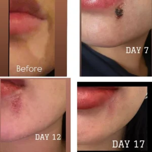 علاج الندبات - scar treatment