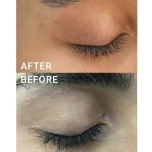 علاج الندبات - scar treatment