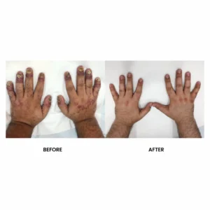 علاح الصدفية - treatment of psoriasis