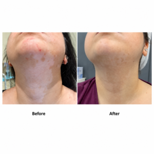 علاج البهاق - Vitiligo treatment