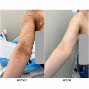 علاج البهاق - Vitiligo treatment
