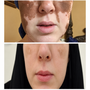 علاج البهاق - Vitiligo treatment
