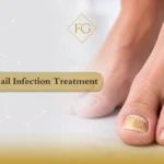 fungal nail infection treatment