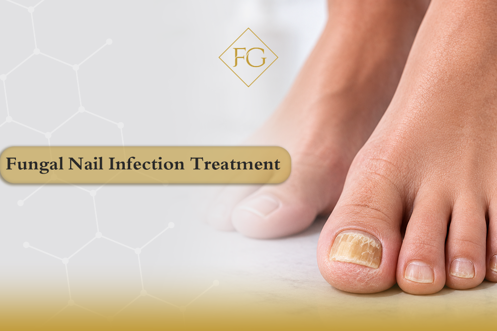 fungal nail infection treatment