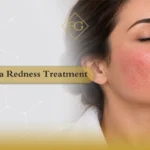 rosacea redness treatment