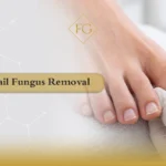 toenail fungus removal
