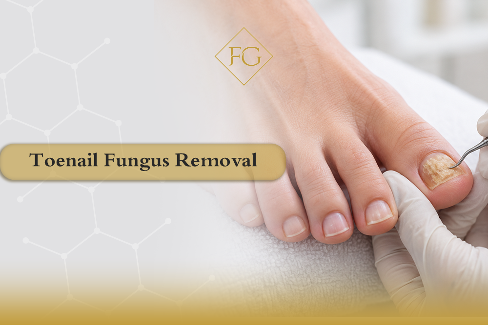 toenail fungus removal