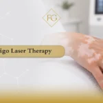 vitiligo skin discoloration