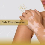 vitiligo laser therapy