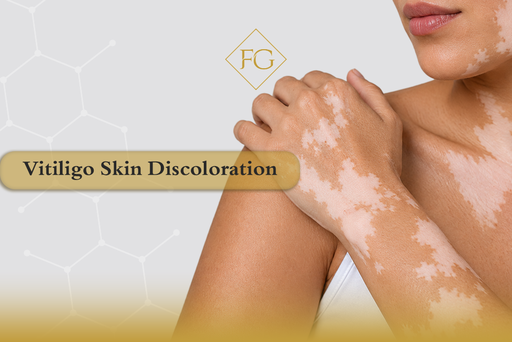 vitiligo laser therapy