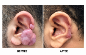 علاج ندبات حب الشباب - scar removal in dubai