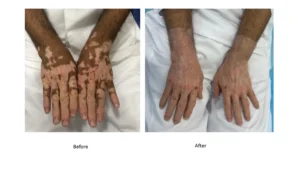 علاج البهاق - Vitiligo treatment
