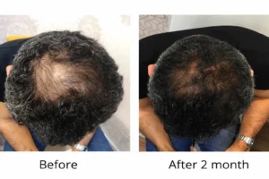 Hair Loss & Alopecia Treatments - علاج تساقط الشعر والثعلبة