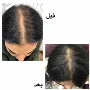 Hair Loss & Alopecia Treatments - علاج تساقط الشعر والثعلبة