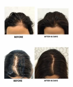 Hair Loss & Alopecia Treatments - علاج تساقط الشعر والثعلبة
