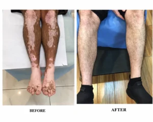 علاج البهاق - Vitiligo treatment