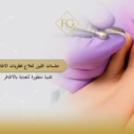 جلسات الليزر لعلاج فطريات الاظافر
