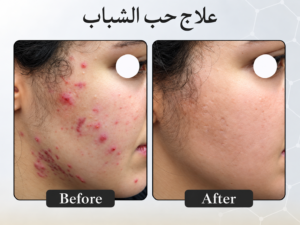علاج ندبات حب الشباب - scar removal in dubai