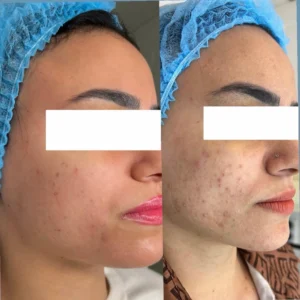 علاج ندبات حب الشباب - scar removal in dubai