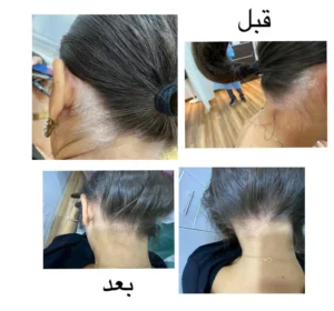 علاح الصدفية - treatment of psoriasis