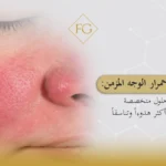 علاج احمرار الوجه