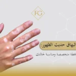 علاج البهاق حديث الظهور